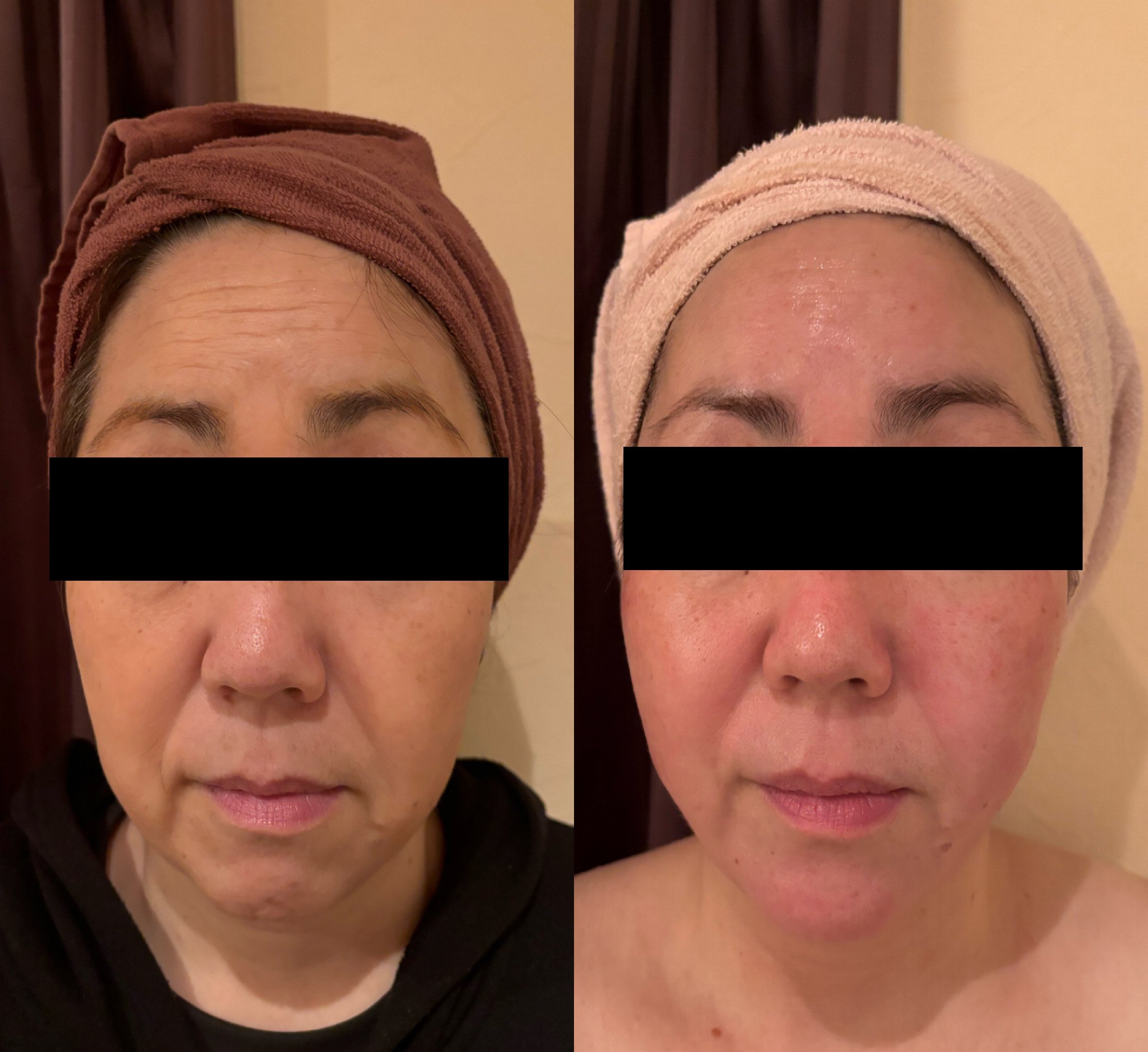 50代 お肌全体のリフトアップ、おでこのシワ、ほうれい線