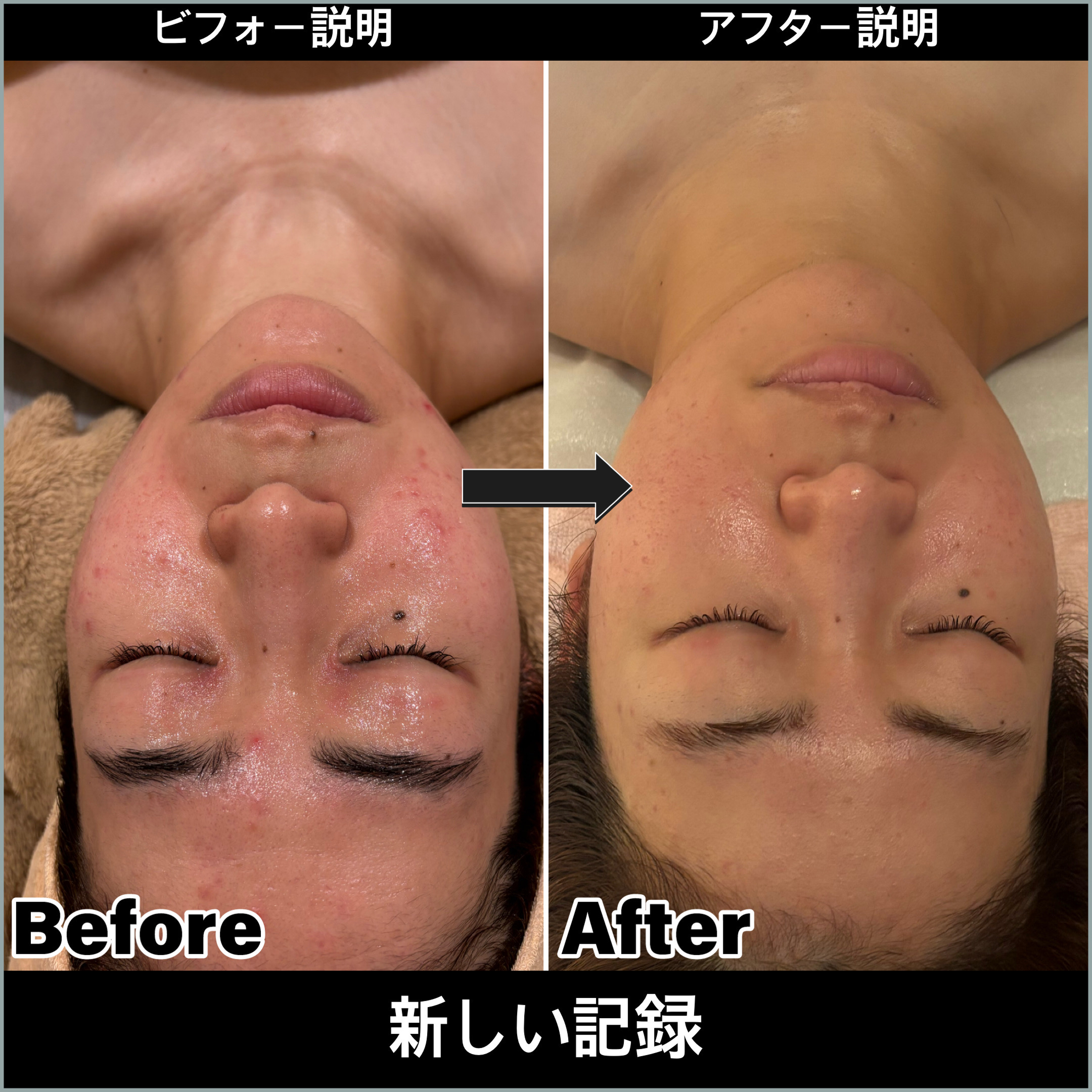 30代 ニキビ肌改善、肌質アップ