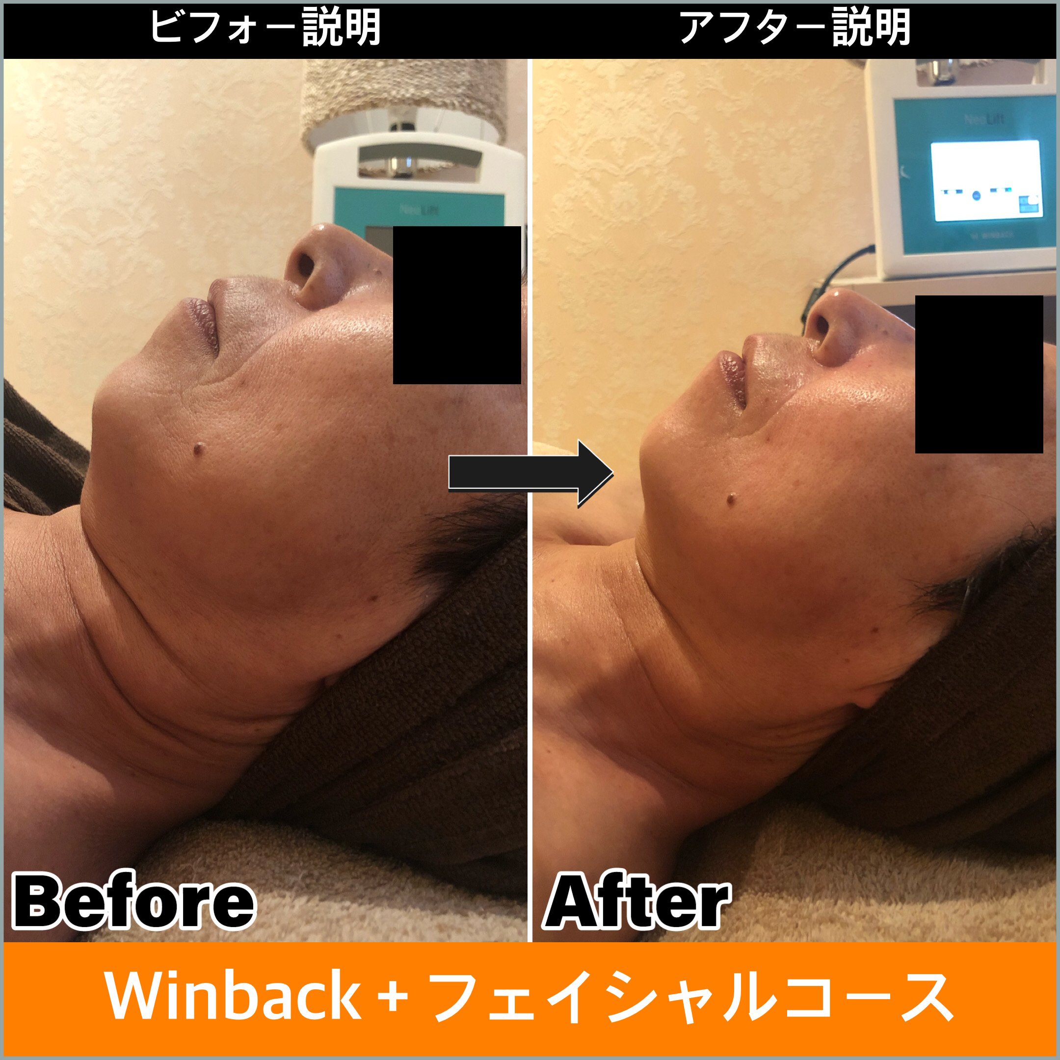 60代 首のシワ、ほうれい線