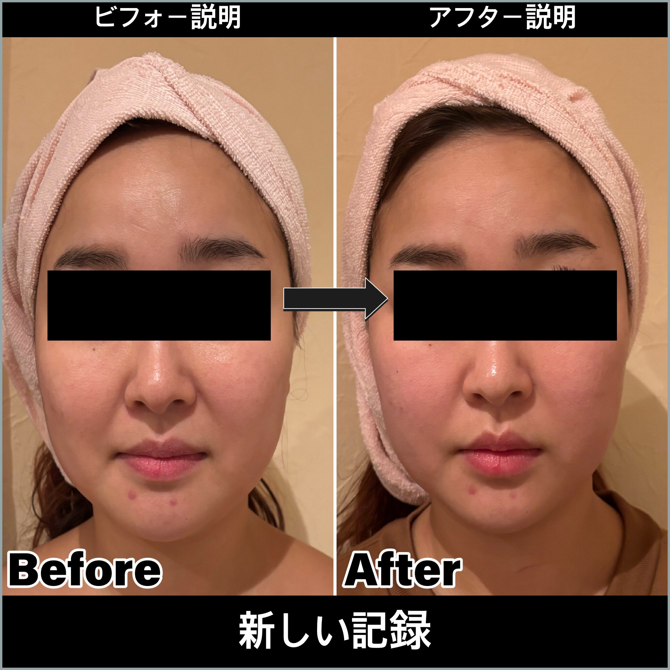 20代 ほうれい線、フェースライン人中縮小