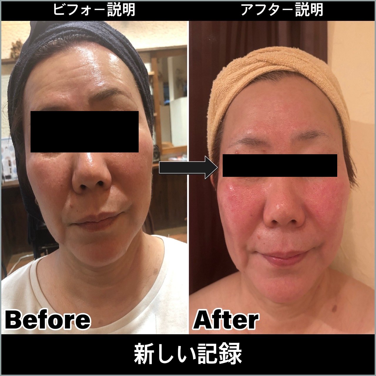 60代 肩こり、五十肩からくる、筋肉の捻れ、顔の歪み