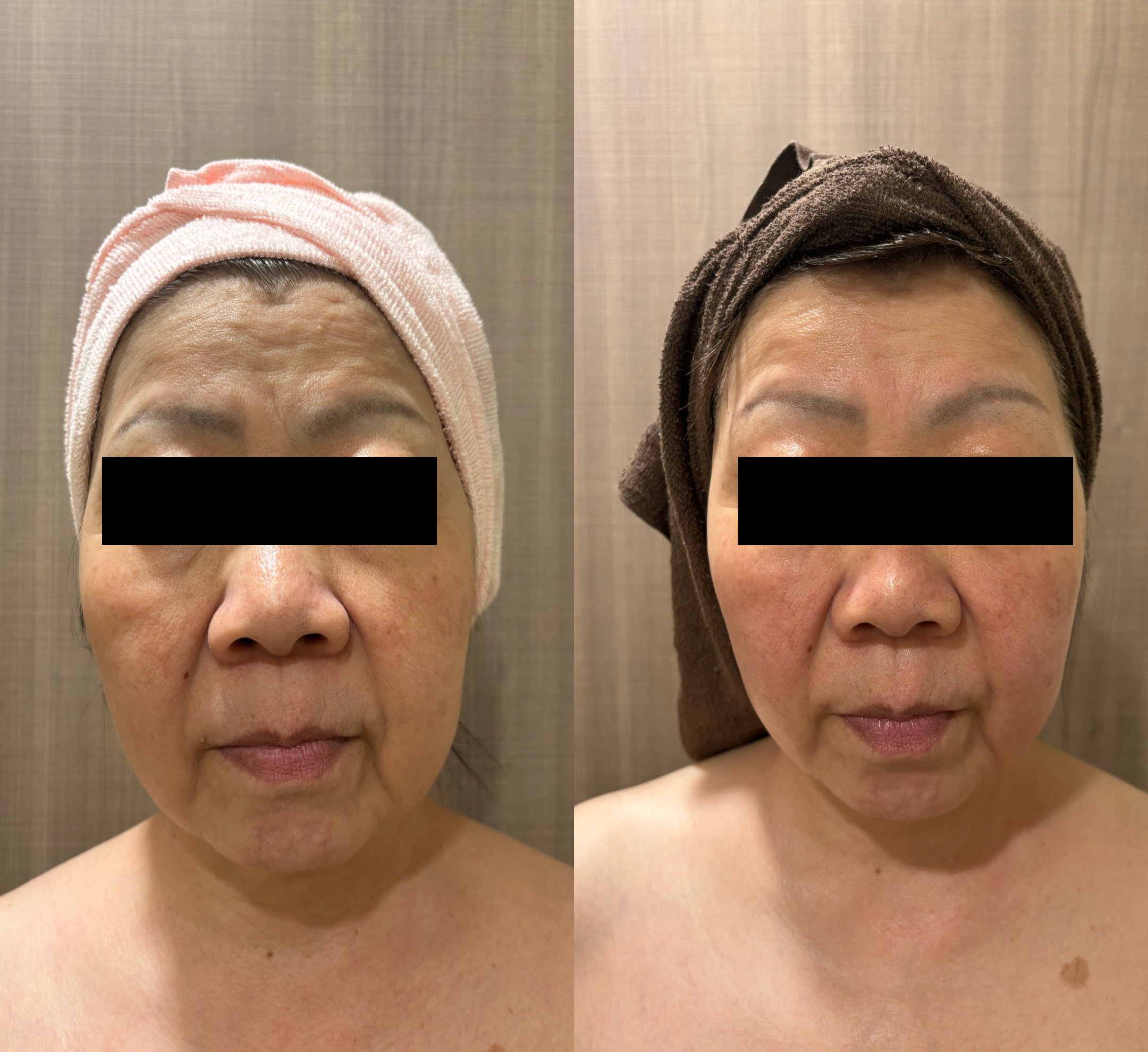 60代 脂肪燃焼、全体的なリフトアップ