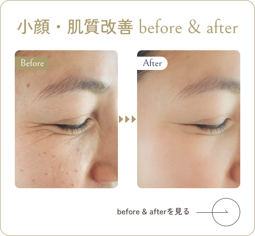 小顔・肌質改善before&after